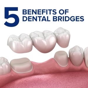 Carson City dentists, Dr. Euse and Dr. Wright at Advanced Dentistry by Design, explains the benefits of dental bridges, providing a reliable solution for missing teeth.