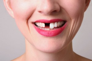 Implants, Independence at your Carson City dentist at Advanced Dentistry by Design.