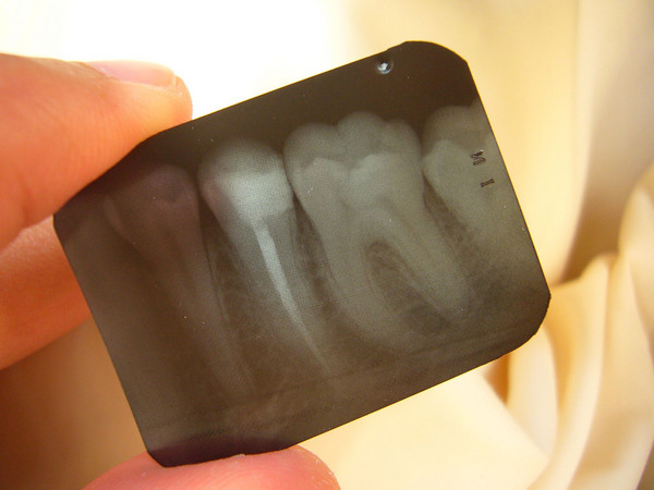 Dental Bridges at your Carson City dentist at Advanced Dentistry by Design.